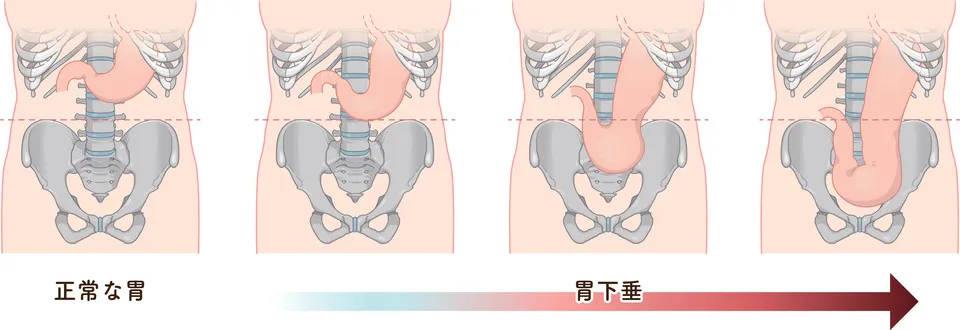 胃下垂